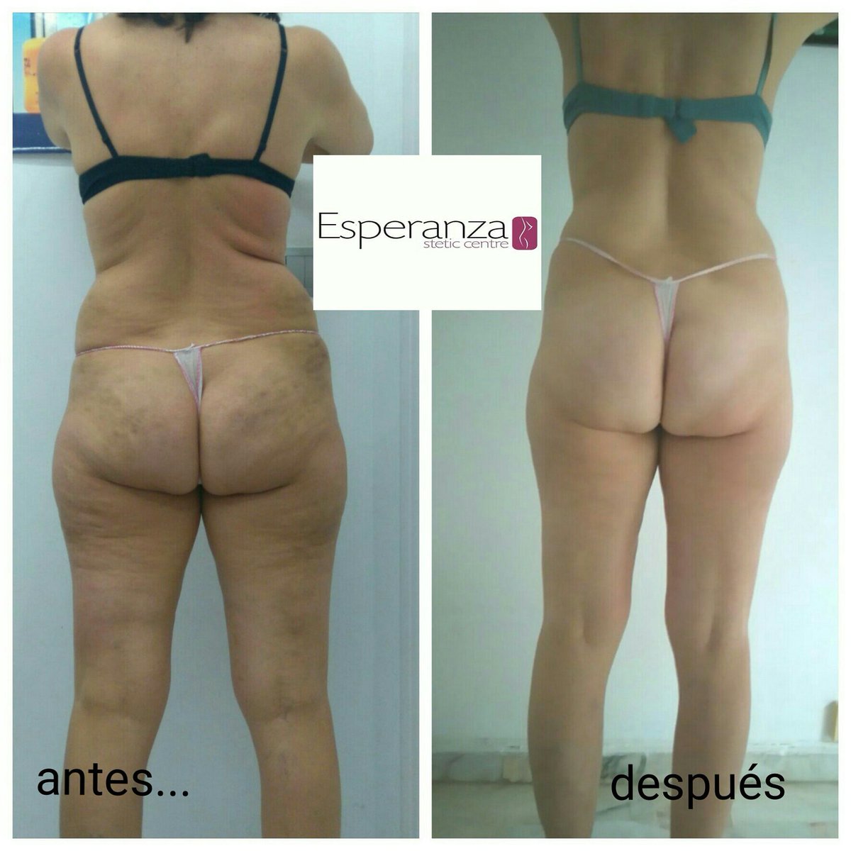 Hoy os mostramos el antes y el después de una de nuestras clientas.
 MESODRENABOLIC  reduce, remodela, adelgaza