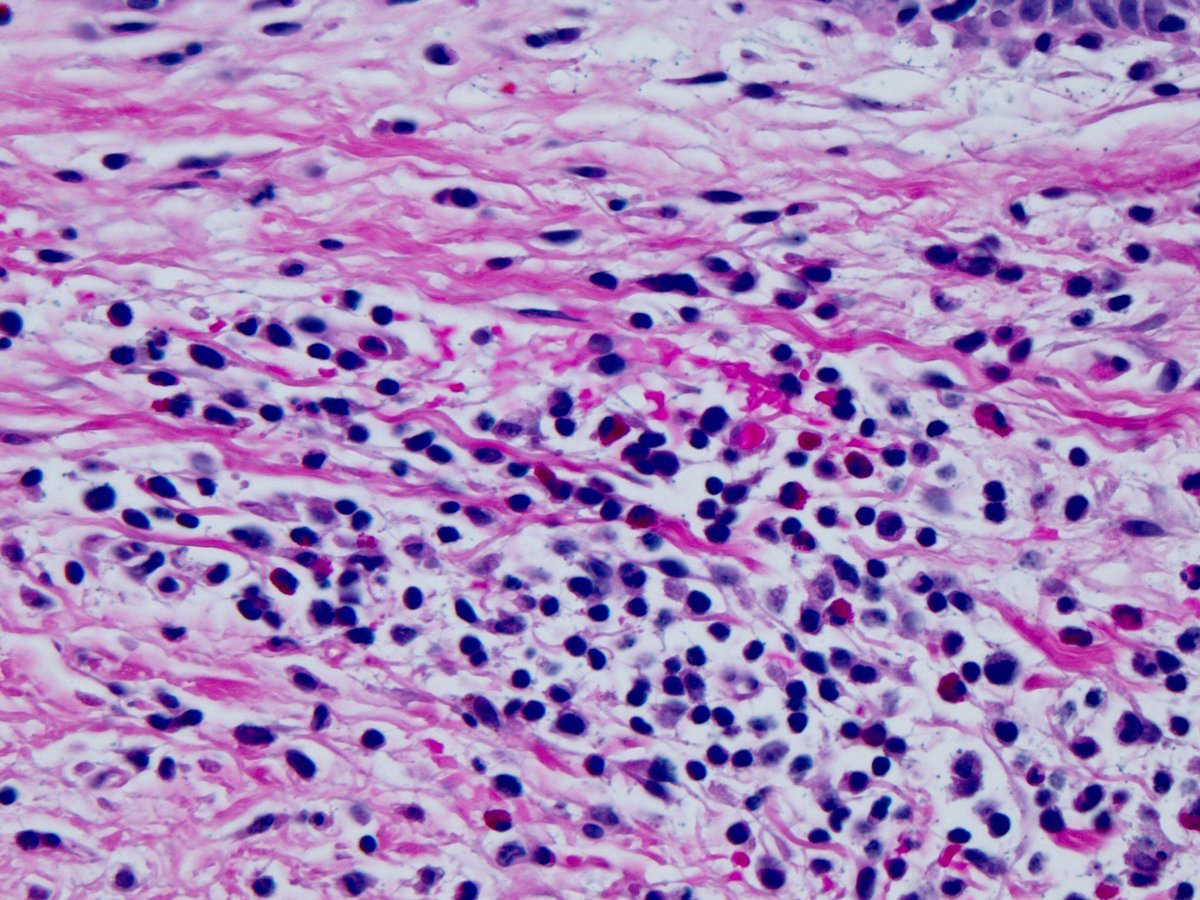 smlungpathguy's tweet photo. Elderly person, tense bullae. Best diagnosis? #knoworfail #dermpath @JMGardnerMD @AnnieMorrisonMD @CArnold_GI https://t.co/Y1NtPvRTre