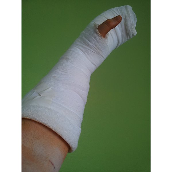 Nach der, fast 2 Stunden langen, OP. Hoffentlich wächst der Nerv wieder zusammen. Dazu erst mal 3 Wochen Gips.