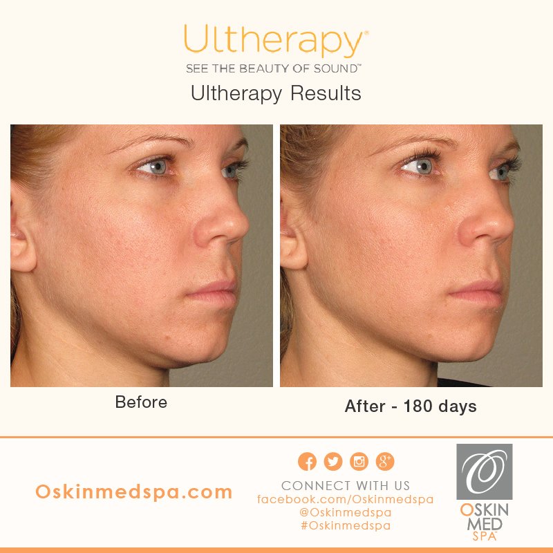 OskinMedSpa's tweet photo. Before &amp; After. #UltherapyResults #Ultherapy #OSkinMedSpa #Skincare #Spa #Beauty  #HealthySkin #FacialTreatments https://t.co/6WoS2LbT5H