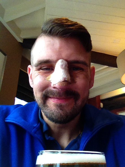 sargered23's tweet photo. After nose job bit swollen still but straight at last! https://t.co/1e8LZv0KtY