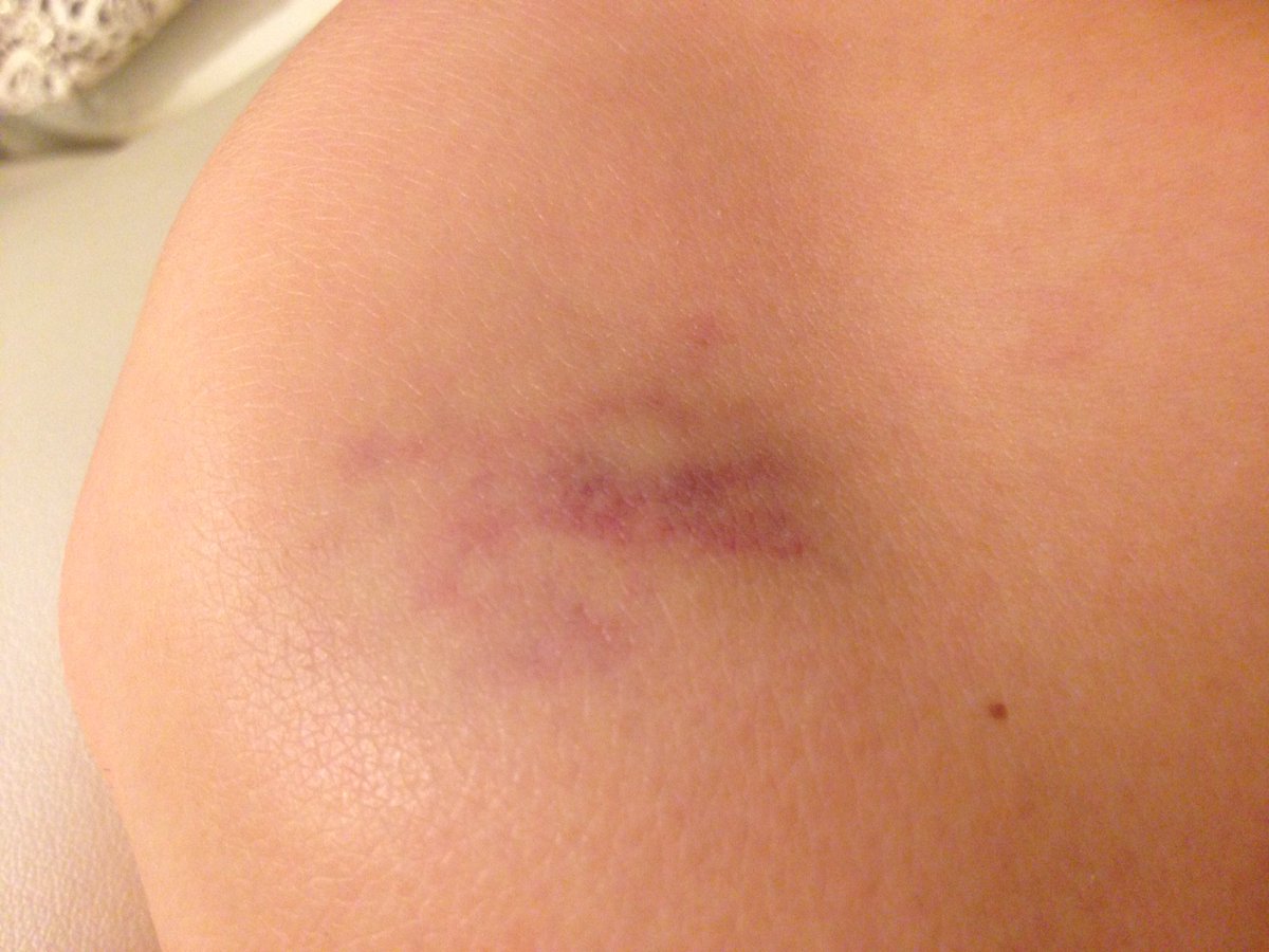 KronNatalie's tweet photo. When your knees are permanently bruised and your bruises have bruises #hurdleprobs https://t.co/I0as5IaDE6