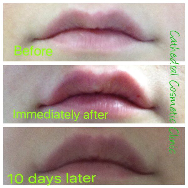 cathedral_cc's tweet photo. Natural fuller looking lips #dermalfiller #lips #TreatTuesday https://t.co/4tRJmDsvK2