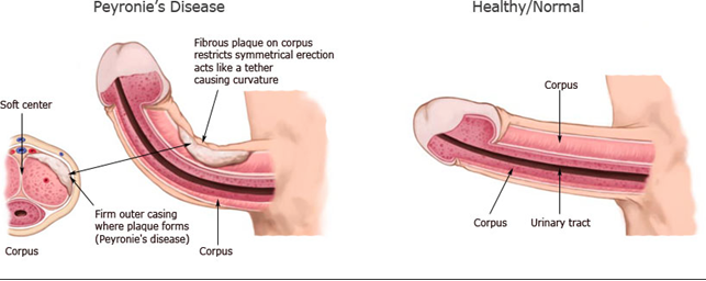 How Does Peyronie's Penis Look Like? bit.ly/1qbTlU9 More photos bit.ly/1qbTmr6 #peyroniespenis