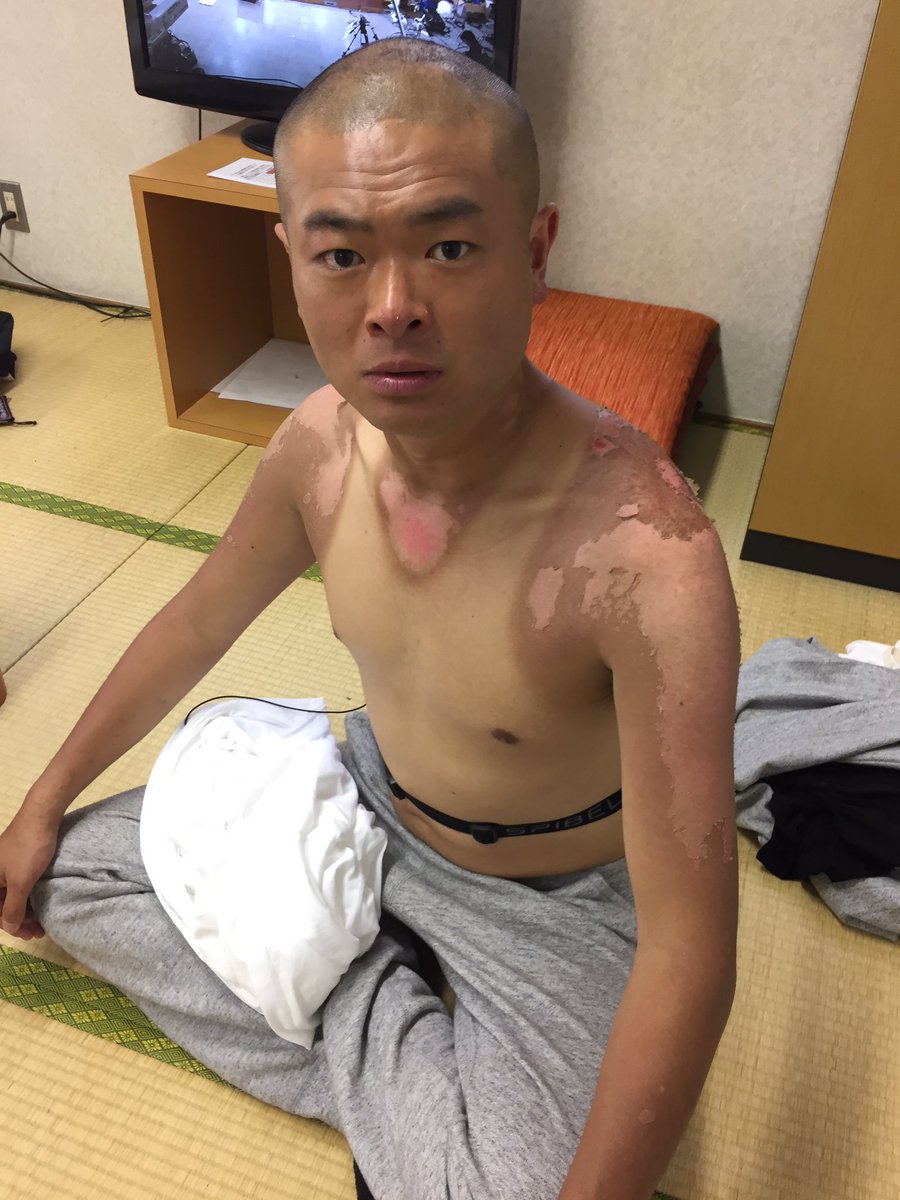 あばれる君の上半身日焼け姿に衝撃 めっちゃ痛そう ライブドアニュース あばれる君の上半身日焼け姿に衝撃 めっちゃ痛そう ライブドアニュース