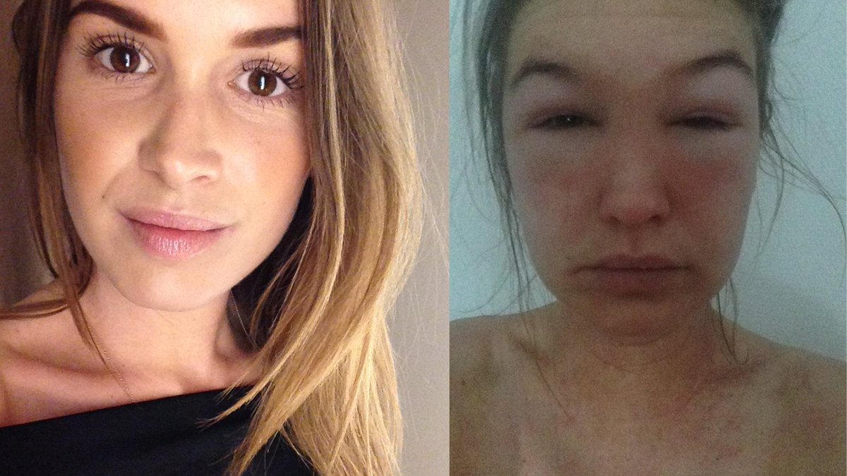 Miild_Makeup's tweet photo. Tanja deler hendes værste allergi oplevelse i dag på bloggen...

https://t.co/dxl9j7hoyR https://t.co/E1czhWwwNM