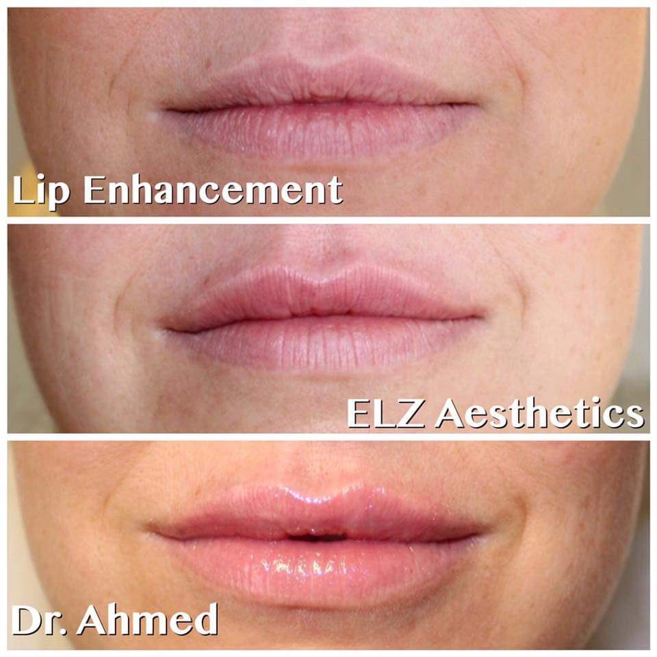 A very satisfied client! With a natural looking lip as requested