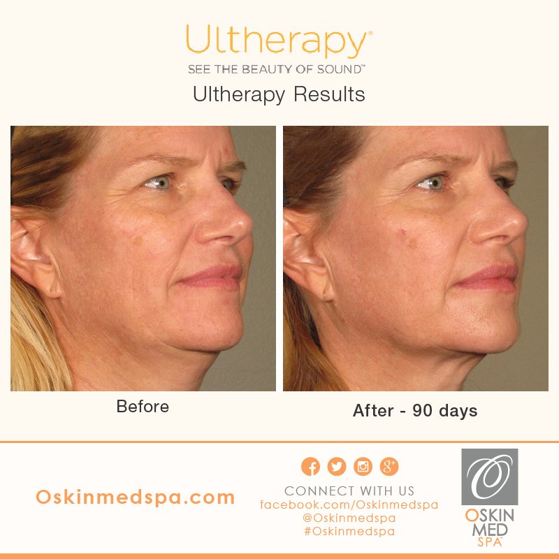 OskinMedSpa's tweet photo. Before &amp; After. #UltherapyResults #Ultherapy #OSkinMedSpa #Skincare #Spa #Beauty  #HealthySkin #FacialTreatments https://t.co/HuNhOYTeux