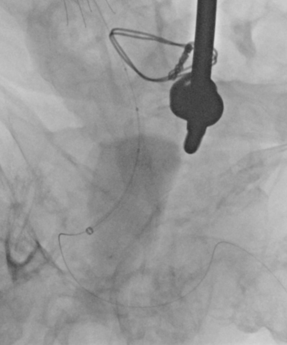 JTassMD's tweet photo. Percutaneous venous fem-fem bypass anyone?  @arslanmd @ozenmerveMD @VIR_RUSH #irad https://t.co/scfqQNfiPg