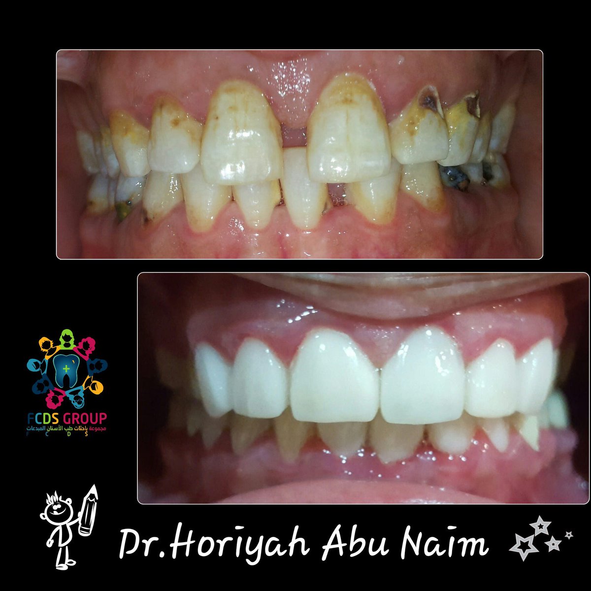 fcdsgroup's tweet photo. طب الأسنان قادر على تغيير ابتسامة إنسان بل تغيير حياته😍👍
شكرا د.حوريه @dr_haroo 

للتفاصيل :
https://t.co/zQ55ibfwnX https://t.co/jIb5bXqrSg