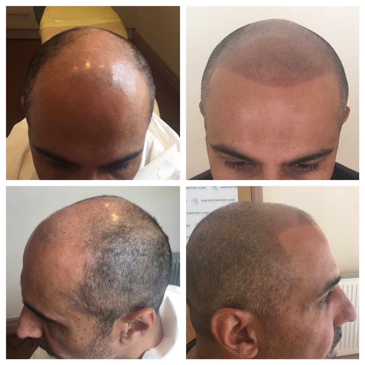 Hayley Ernest On Twitter Scalpmicropigmentation Scalp Tattoo