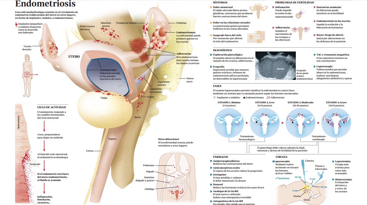 Endometriosis cirugia