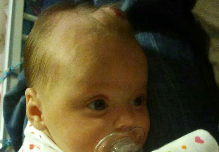 wearesouthdevon's tweet photo. It's #Vbfawareness day. Here's my little 'H' baby (not so little now!) @BirthmarkSG @VBirthmarks #AskAccept https://t.co/2H6t18LhK7