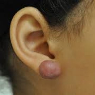 LSBPIndonesia's tweet photo. apa saja yg dpt dilakukan utk mengatasi keloid? Pelajari di ASC Batch 7!
Email: Lsbpindonesia@gmail.com https://t.co/phmlXAvisB