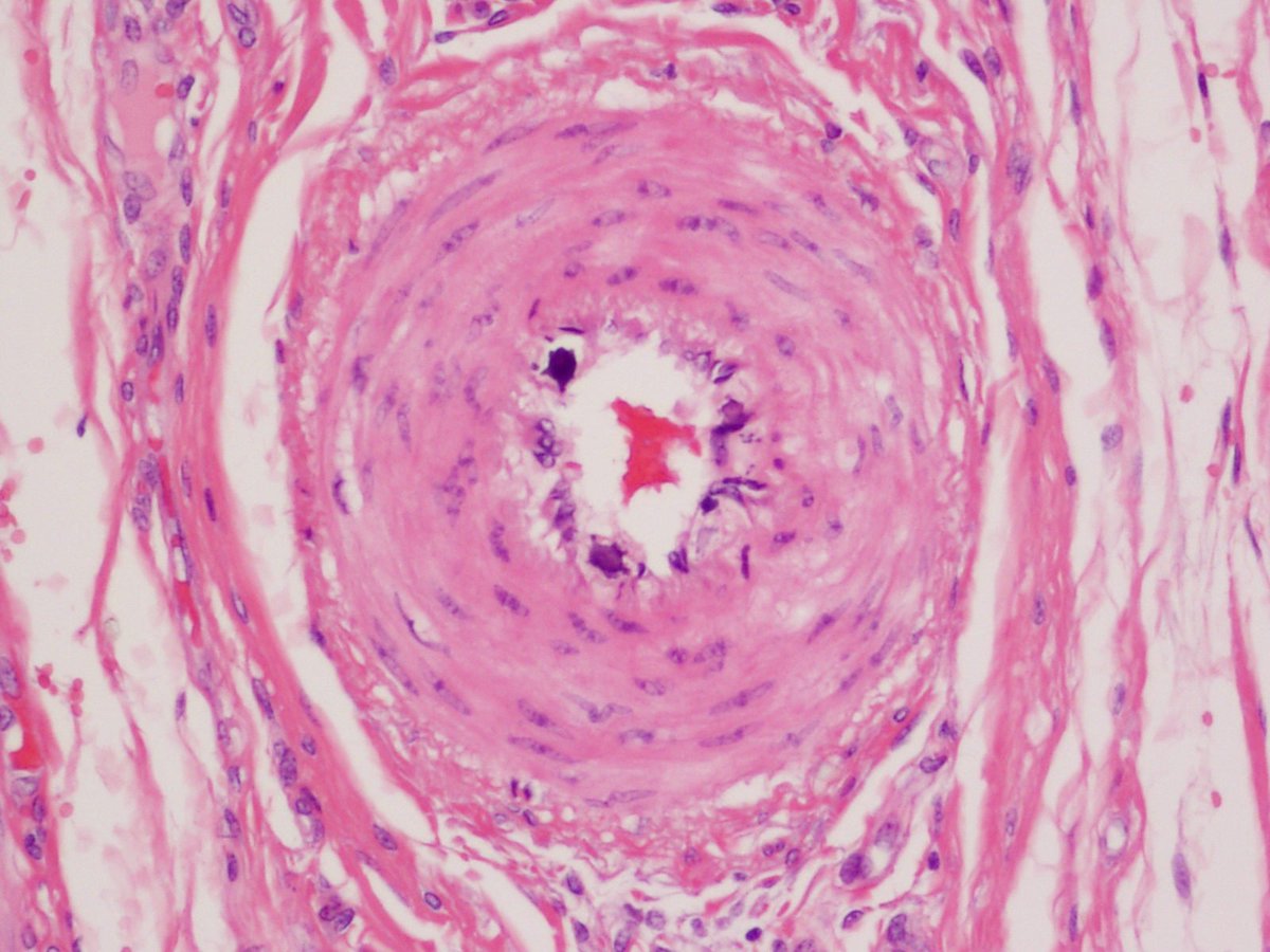 katevetpath's tweet photo. Equine #asteroidbody. Nice revision for #vetstudents #vetpath #histopathology. https://t.co/5EbRRg0GSu