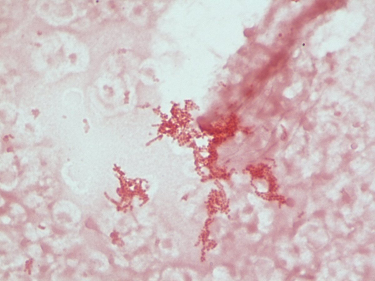 LSUHSCID's tweet photo. Blood culture with pleomorophic gram negative tetrads. Grows best on chocolate. https://t.co/rcYWOWivUN