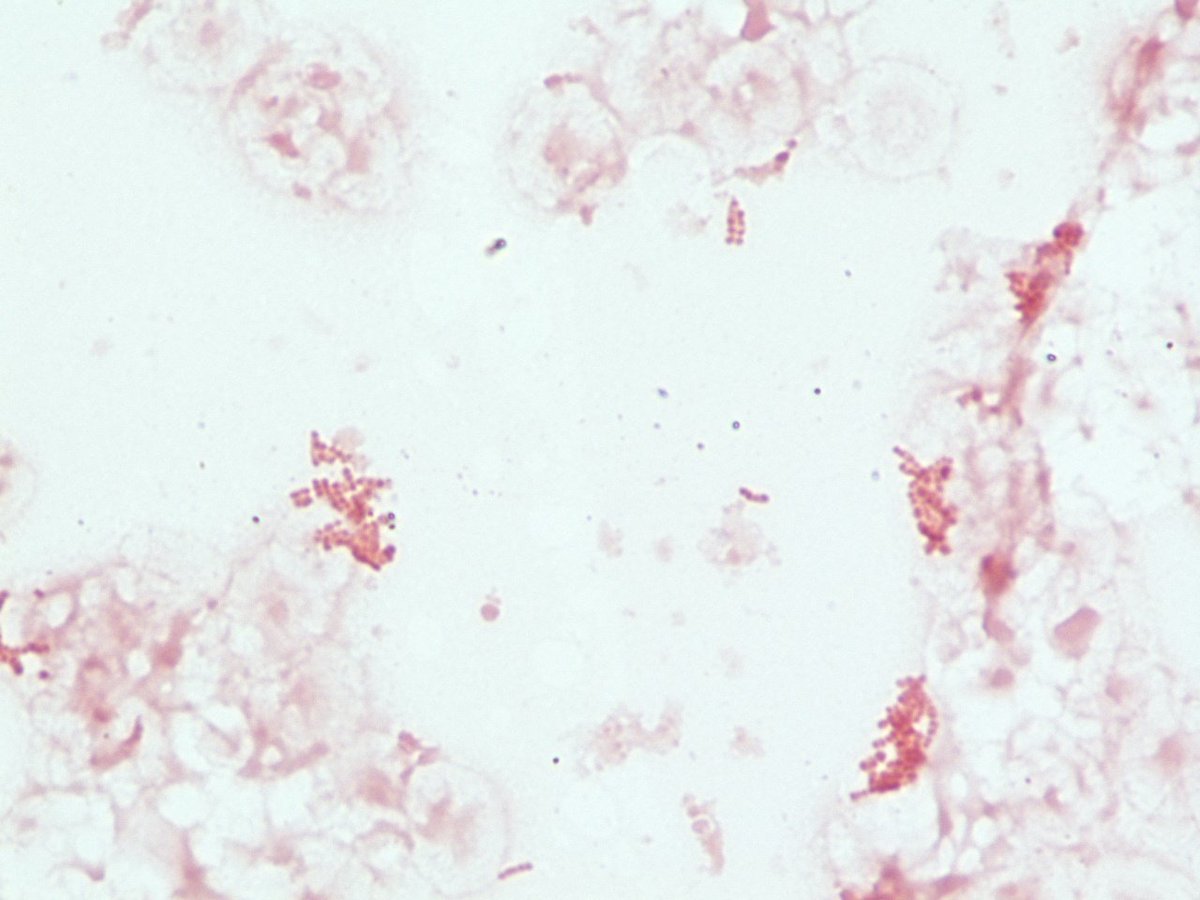 LSUHSCID's tweet photo. Blood culture with pleomorophic gram negative tetrads. Grows best on chocolate. https://t.co/rcYWOWivUN
