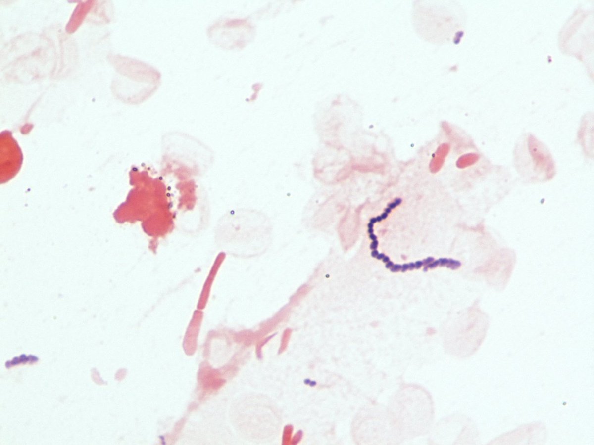 LSUHSCID's tweet photo. 66 yr old male with AMS and AKI. LP shows 100 WBCs and 200 RBCs. BCX with S aureus. CSF is shown. https://t.co/MBCkzwKTqL