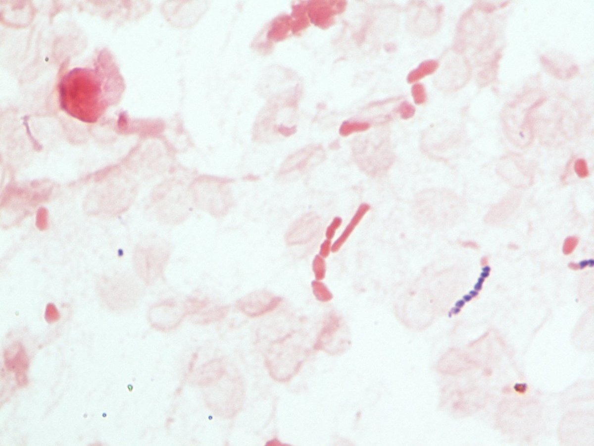 LSUHSCID's tweet photo. 66 yr old male with AMS and AKI. LP shows 100 WBCs and 200 RBCs. BCX with S aureus. CSF is shown. https://t.co/MBCkzwKTqL