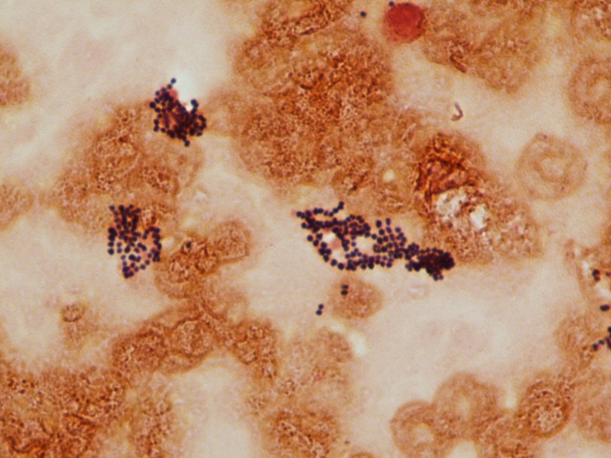 LSUHSCID's tweet photo. 66 yr old male with AMS and AKI. LP shows 100 WBCs and 200 RBCs. BCX with S aureus. CSF is shown. https://t.co/MBCkzwKTqL