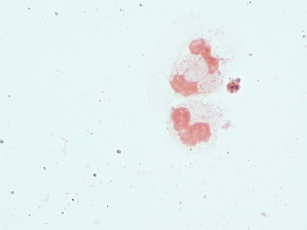 LSUHSCID's tweet photo. Pt w/CDiff colitis and fever. Blood cultures isolateGPCs possible alpha hemolytic strep. https://t.co/CEWi5TYfaG