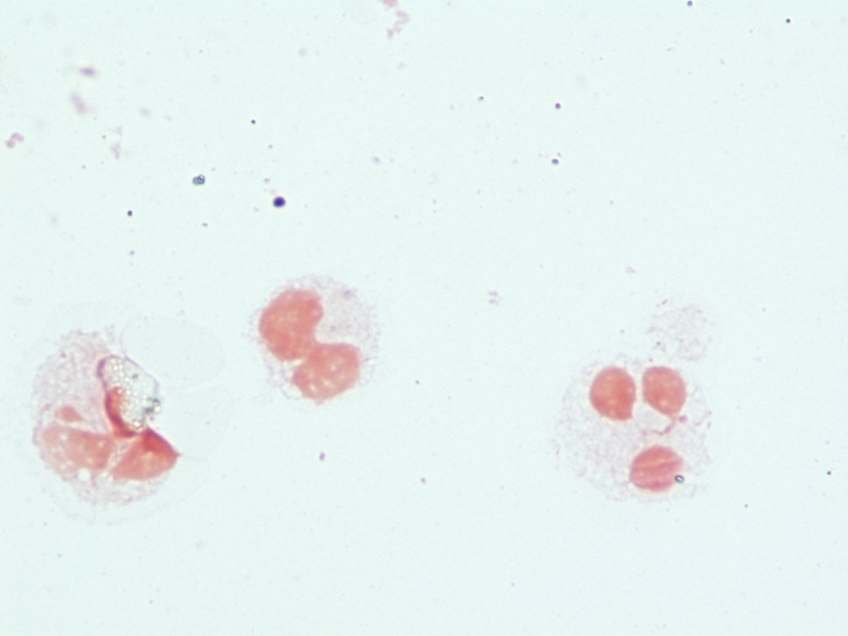 LSUHSCID's tweet photo. Pt w/CDiff colitis and fever. Blood cultures isolateGPCs possible alpha hemolytic strep. https://t.co/CEWi5TYfaG