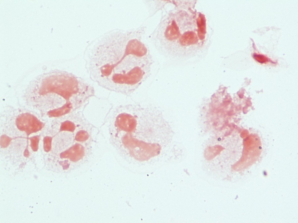 LSUHSCID's tweet photo. Pt w/CDiff colitis and fever. Blood cultures isolateGPCs possible alpha hemolytic strep. https://t.co/CEWi5TYfaG