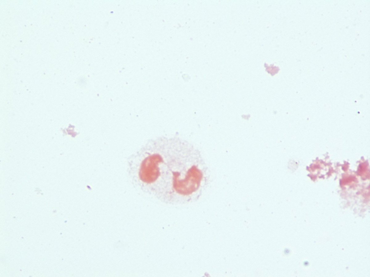 LSUHSCID's tweet photo. Pt w/CDiff colitis and fever. Blood cultures isolateGPCs possible alpha hemolytic strep. https://t.co/CEWi5TYfaG