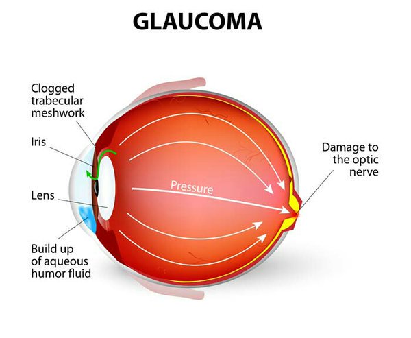 New evidence supports genetic basis of glaucoma natureasia.com/en/nmiddleeast… #glaucoma #genetics #genes