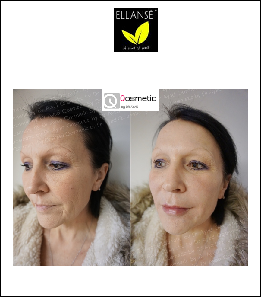 Ellanse_Global's tweet photo. Fantastic results! Before and after Ellanse pictures from the Qosmetic Clinic by Dr Ayad. https://t.co/27euWnjUzb. https://t.co/Paq2IxM6Jb