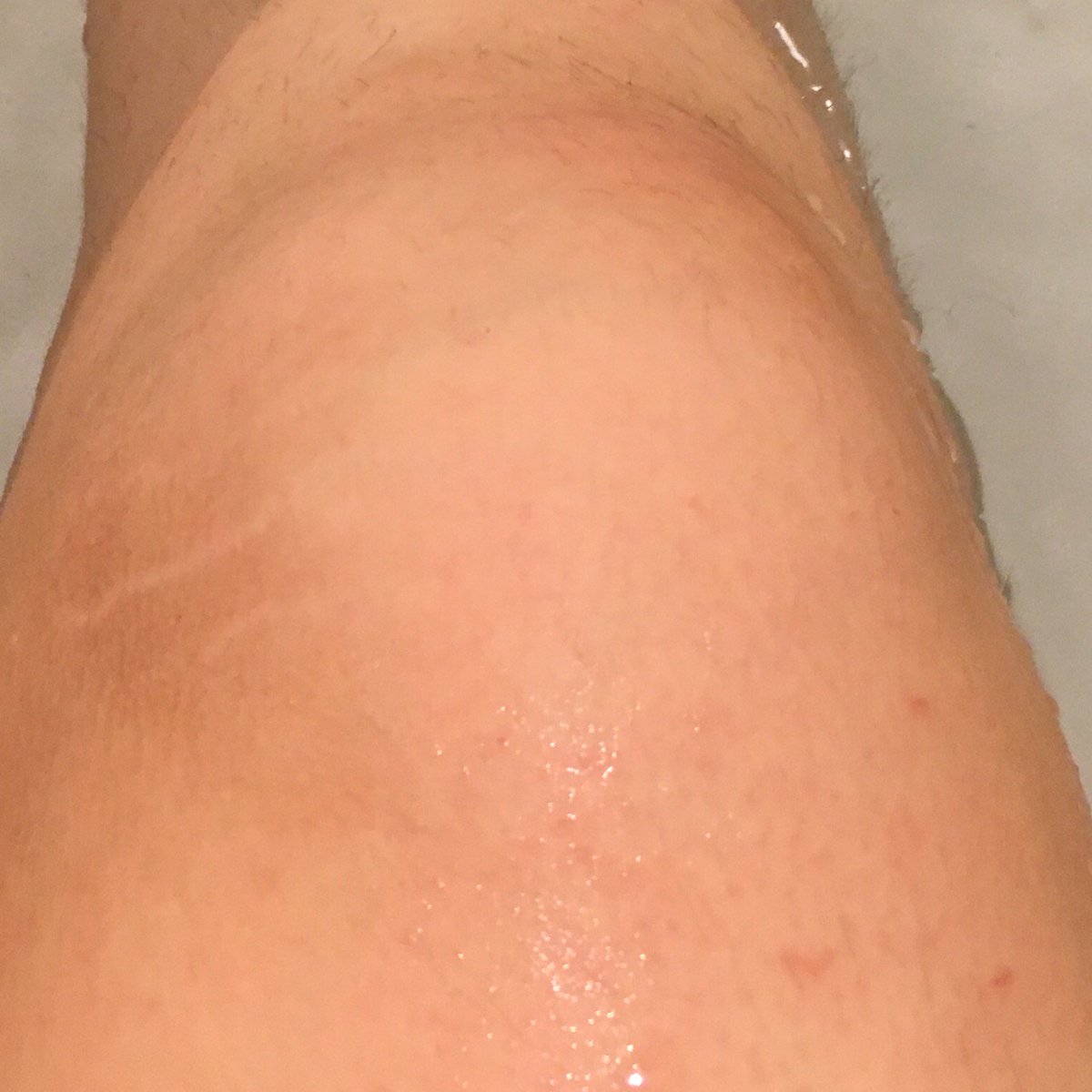 prpltnkr's tweet photo. See this knee? Pain lives here. This is a sad knee. #broknee https://t.co/uCYGVJbhLb