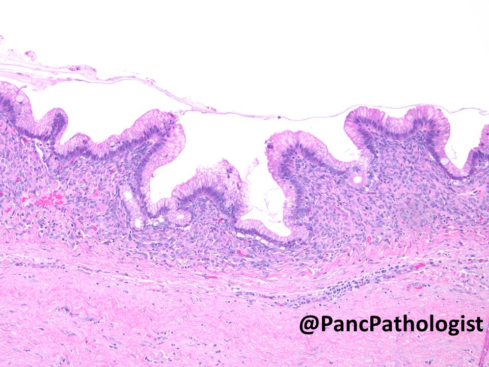 PancPathologist's tweet photo. Mucinous Cystic Neoplasm preop KRAS +, precursor #PancreaticCancer #GIPath #Pathology https://t.co/TTodoZdzaj #DDW16 https://t.co/xSg9BSskjT