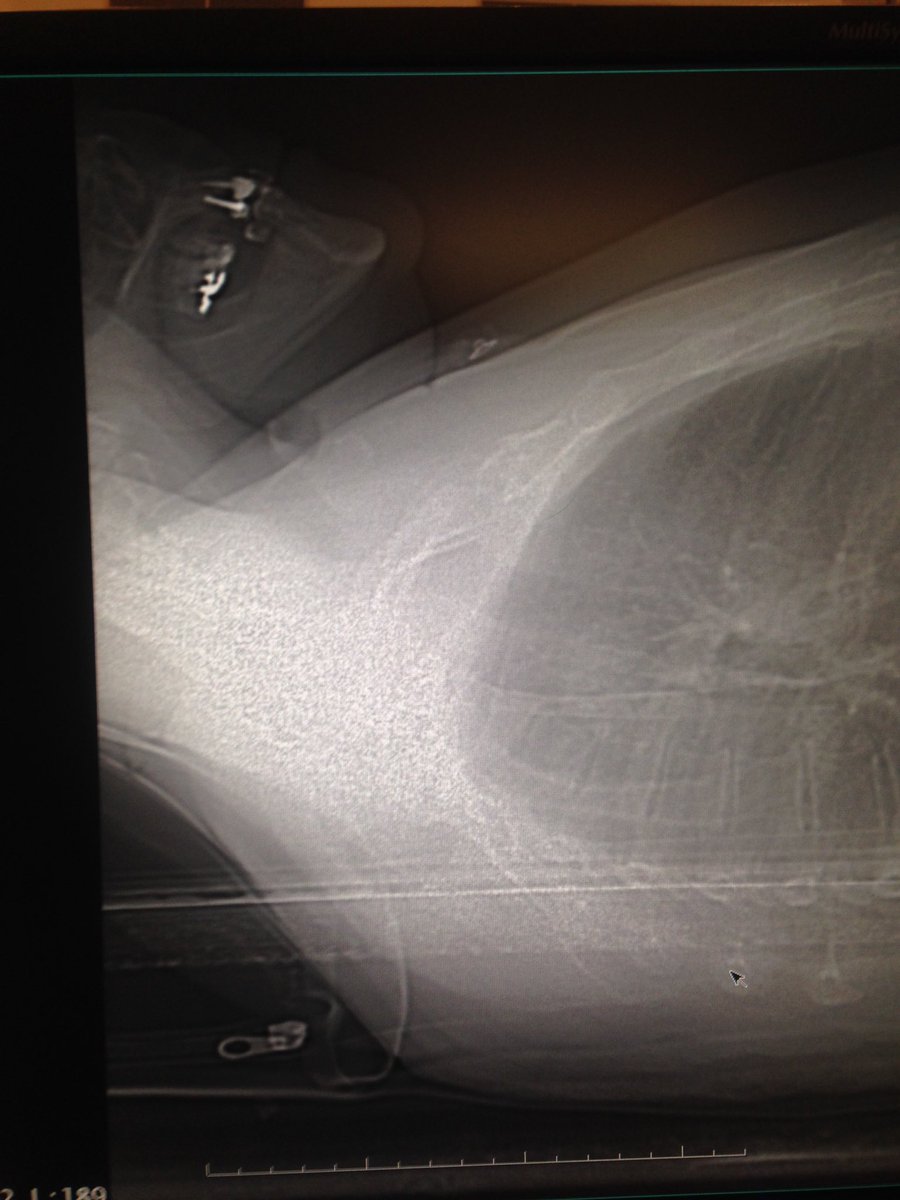IagoMtnezSouto's tweet photo. Nueva técnica d implante dental abre fácil??? Noooo! Es el resultado d  imagen 2D 😅 #Radiologia Siempre atentos😜 https://t.co/Eytged1ZAs