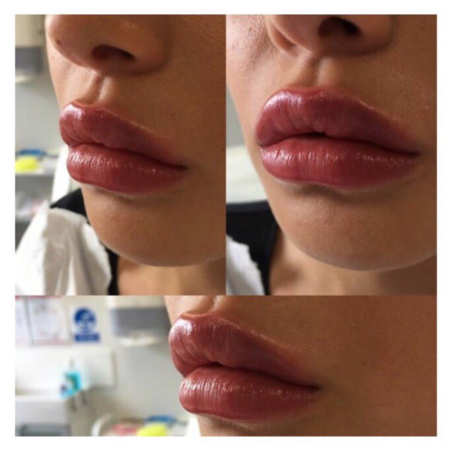cosmeticcouture's tweet photo. #models required this week just £99 for 1ml #lipfillers #hdlips #intraline call 01618323236 https://t.co/QZdBvOQKlW
