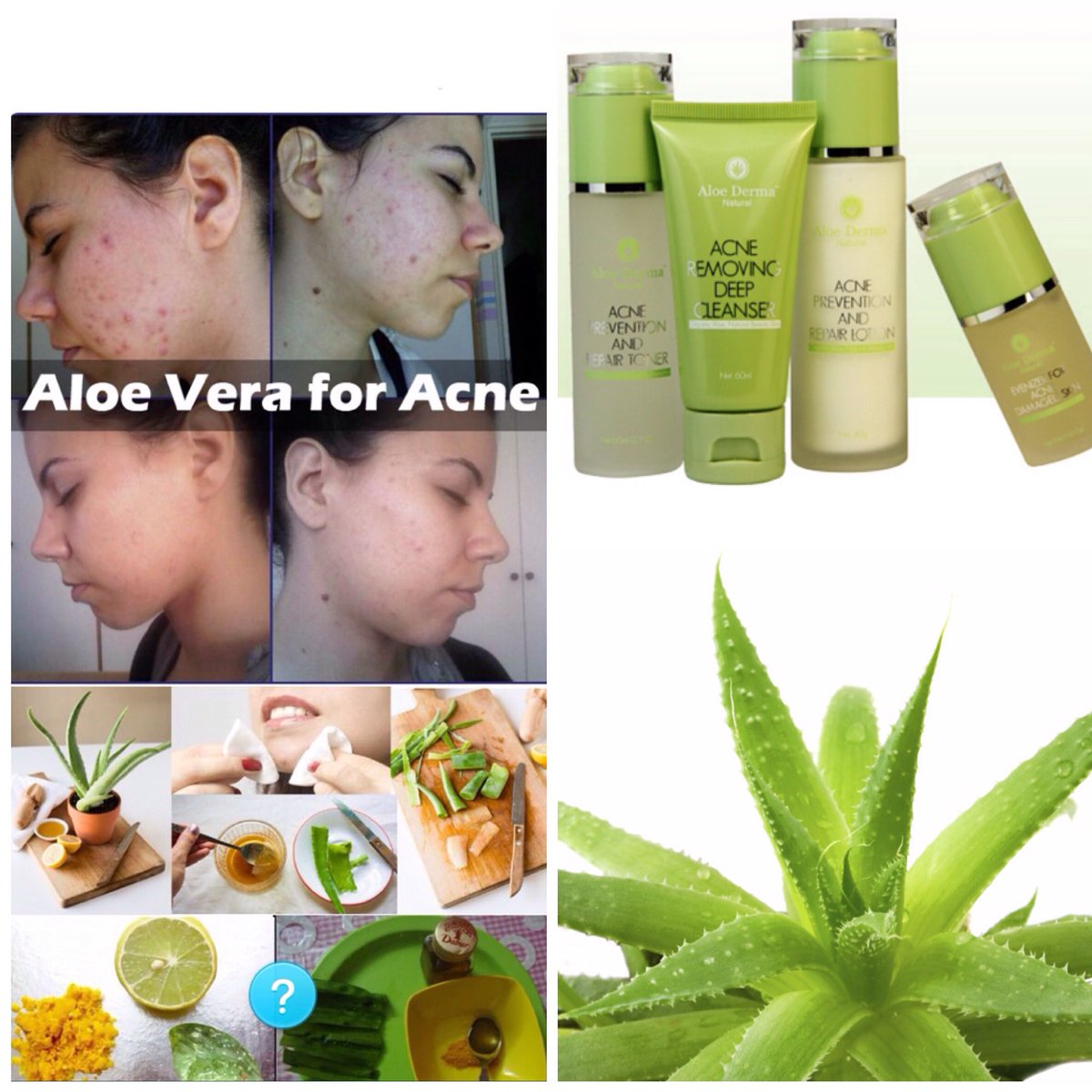 luchando con Acne #AloeDerma te muestra su;
Kit Anti Acne Jabon tónico y evenizer o regenerador de piel