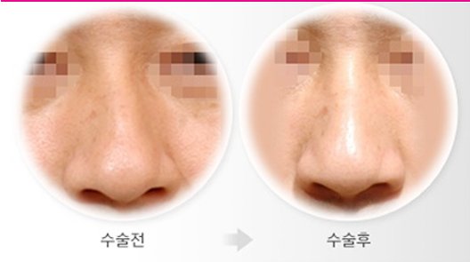 Migo_Clinic's tweet photo. Deviated nose correction by Dr. Kang Eun Taek. #deviatednose #plasticsurgery #nose #korea #rhinoplasty #migo #Seoul https://t.co/odM3LdDhfi