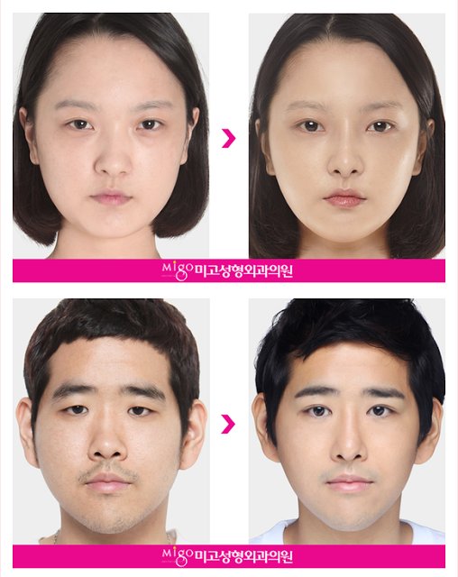 Migo_Clinic's tweet photo. Deviated nose correction by Dr. Kang Eun Taek. #deviatednose #plasticsurgery #nose #korea #rhinoplasty #migo #Seoul https://t.co/odM3LdDhfi