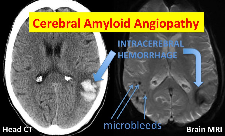 #amyloidangiopathy newsletter 6: Hx of @CAA_Disease Cerebral Amyloid Angiopathy #StrokeMonth bit.ly/23W0mpA