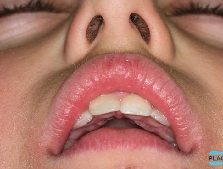Vigila la respiración de tu hij@, ¿es oral o nasal? Solucionalo con la #placaconfort