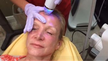 sociableaesthet's tweet photo. Hair regeneration is possible with #microneedling, see more: https://t.co/dcXkTHqaEP https://t.co/f7y5VVkmSV