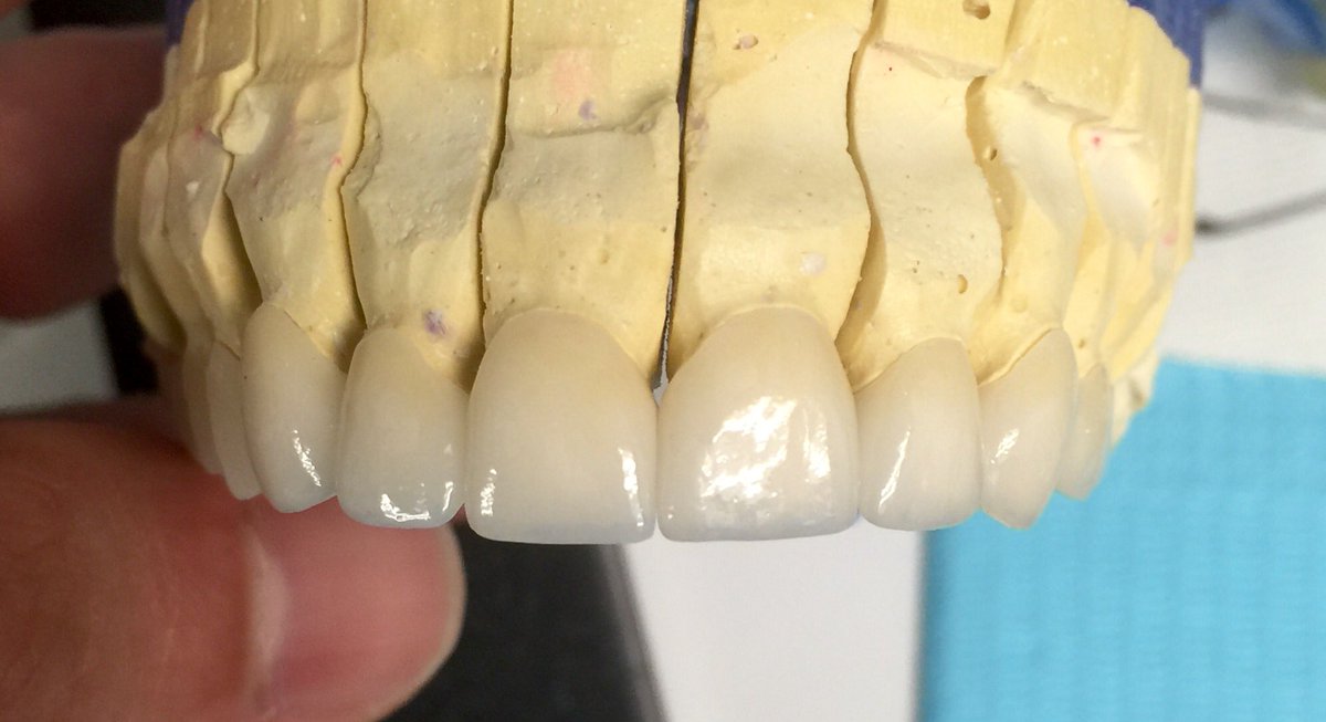 drandrewjkeller's tweet photo. Bellevue Dentist Dr. Andrew Keller 10 unit veneer case of Emax Porcelain https://t.co/jKUCKZSd5K #bellevuedentist https://t.co/G16uPJ2tmW