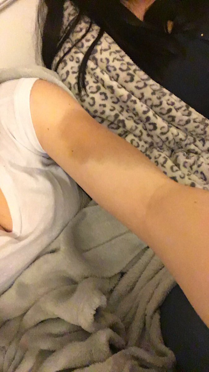 _amyhucker's tweet photo. I hate bruises🙄🙄🙄 https://t.co/2O2fsWbVSP