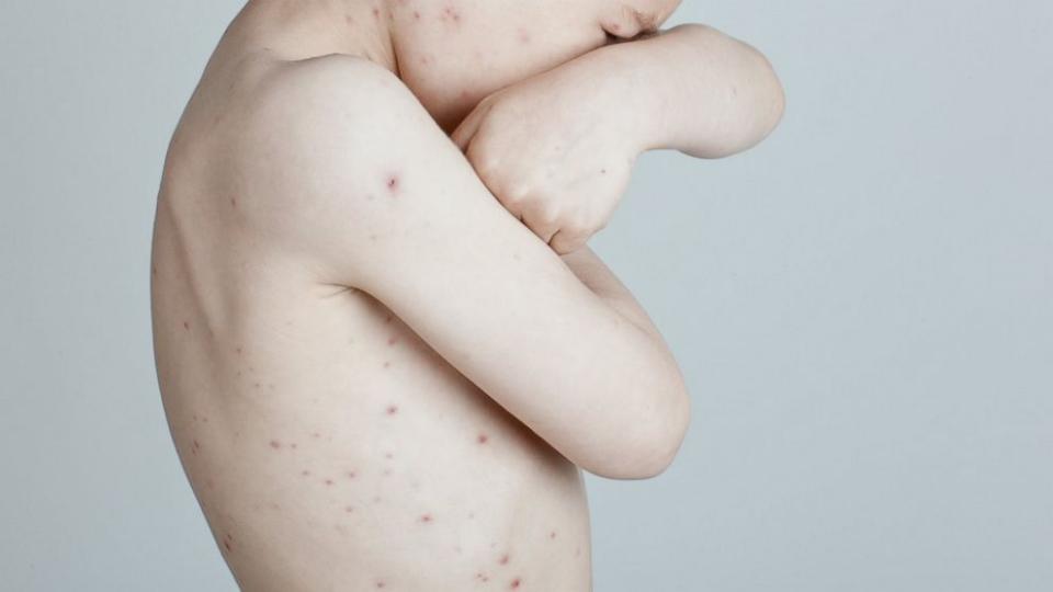 GMA's tweet photo. Health officials investigating chicken pox outbreak that has infected dozens of children: https://t.co/4SVJQEUguo https://t.co/4i4zA1py2R