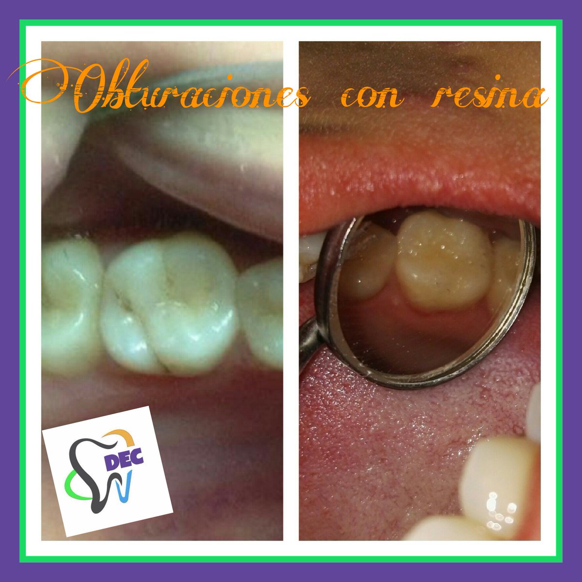 No dejes que una carie avance comunicate a los numero 32414252 y 89795494