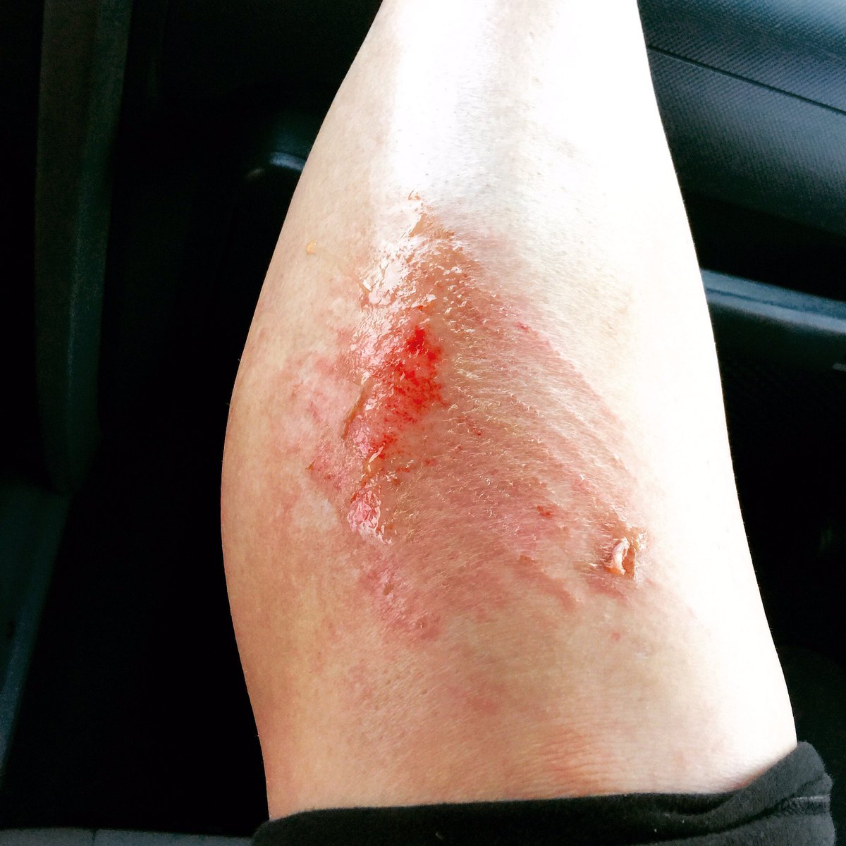 ashlbechtel's tweet photo. You know it's summer when your leg looks like this.. #softball #nevergoingtolearn #2ndsummerinarow #iwassafe ⚾️👌🏼 https://t.co/iDrTM5tDz5