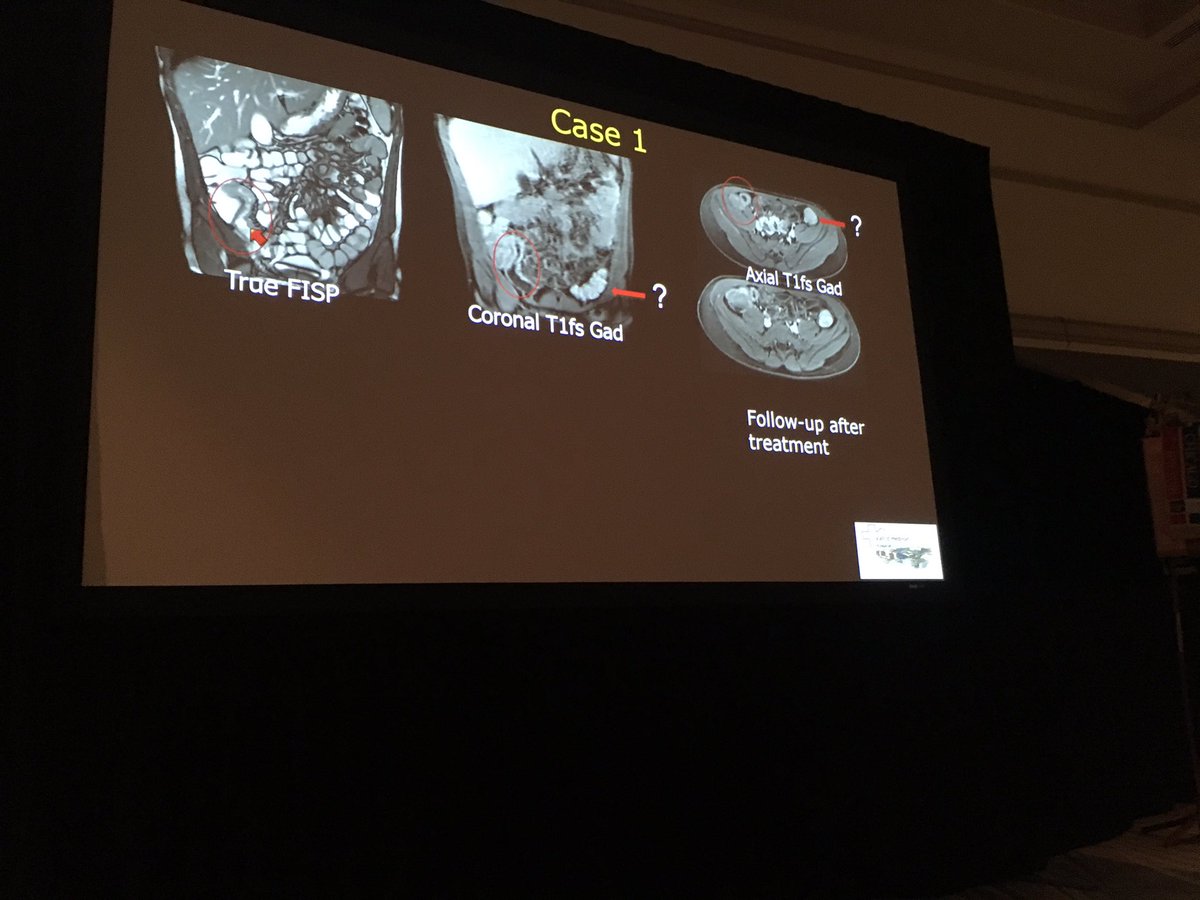 fermgmez's tweet photo. Great lecture from Dr. Ignaci Barber about IBD in children at #IPR2016 @HSJDBCN https://t.co/8byub73RQs