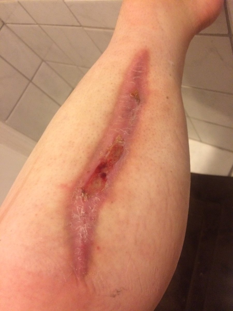 Mikayla_link's tweet photo. I'm able to workout again! Time to get fit! #legprogress #healing https://t.co/D2yqs5ajxE