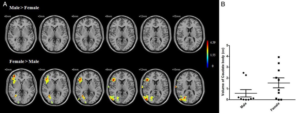 drmike001's tweet photo. Gender differences in the neural response to #acupuncture... https://t.co/4zGLIoLL5E https://t.co/1onHRGdq9N