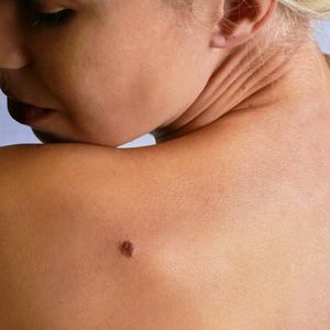 FinancialHealth's tweet image. Gympie melanoma rates on par with state hubs.ly/H039t5T0 #health #Qld