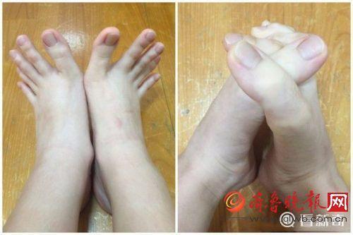 XHNews's tweet photo. Chinese girl gets popular online for having unusually long toes. Others shake hands, she can easily shake feet https://t.co/tis0R18Yzf